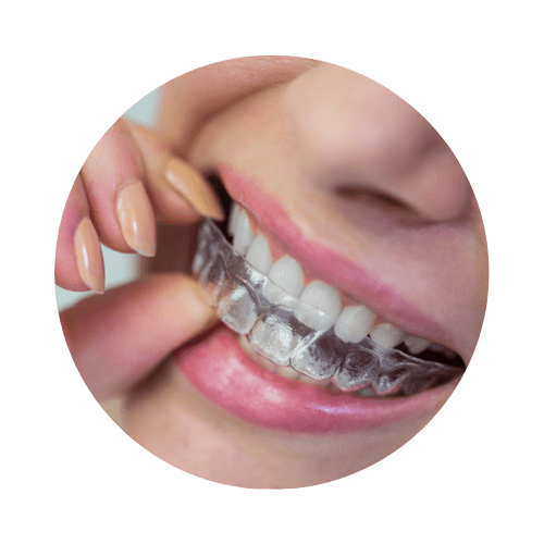 invisalign point