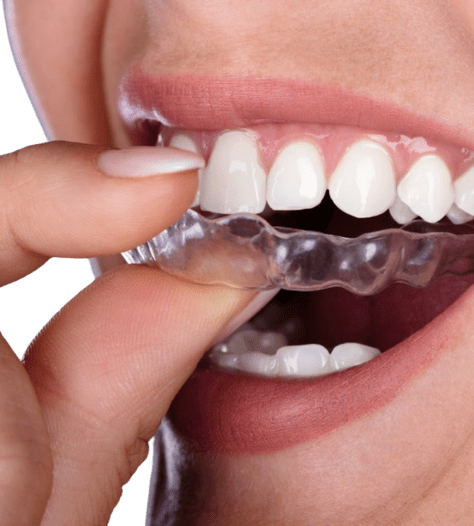 clear aligner