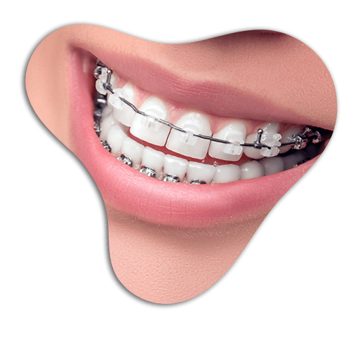 Ceramic-Braces