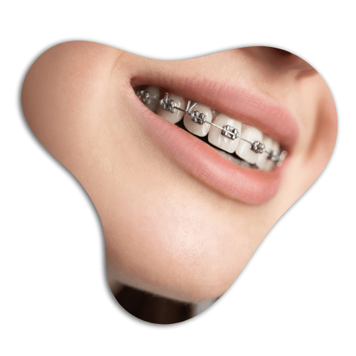 Metal-Braces