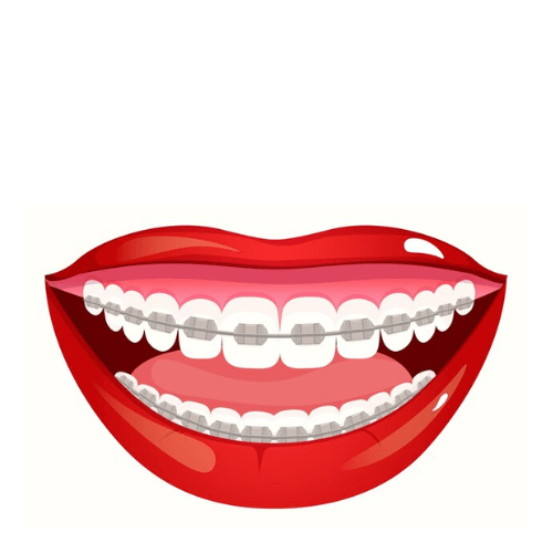 Metal-Braces