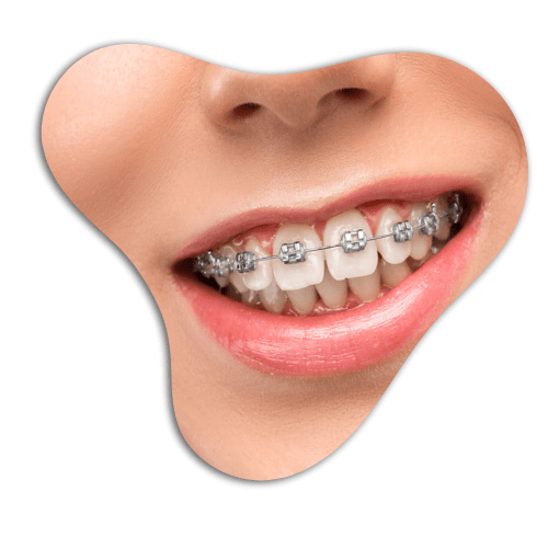 Self-Ligating-Braces