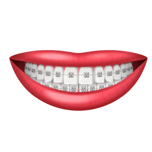 Self-Ligating-Braces